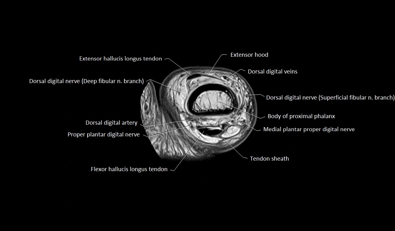 Great toe (hallux) axial microanatomy 3T MRI image 17.webp